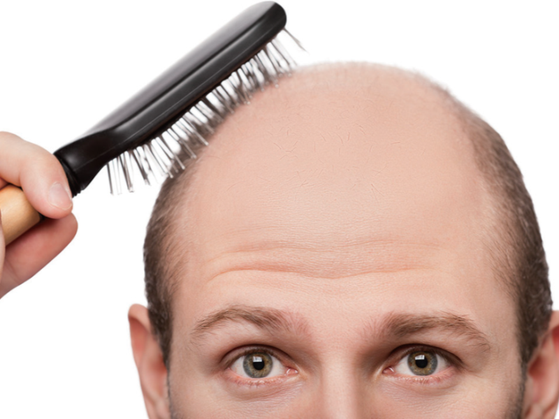 拯救禿頭！控制毛囊生死的化學物質